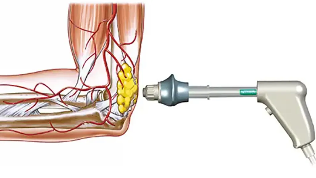 shockwave therapy vs laser therapy
