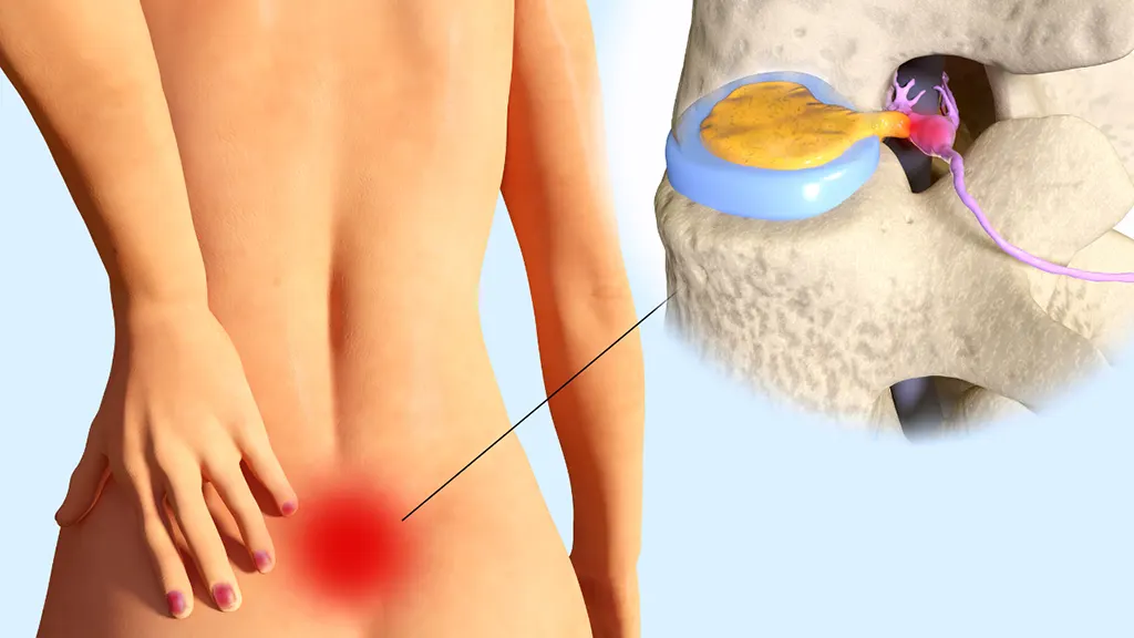 Spinal Stenosis VS Herniated Disc: How to Tell them Apart