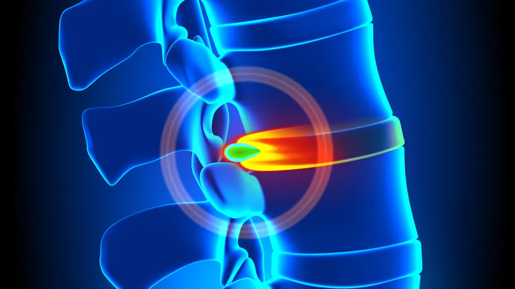 disc herniation