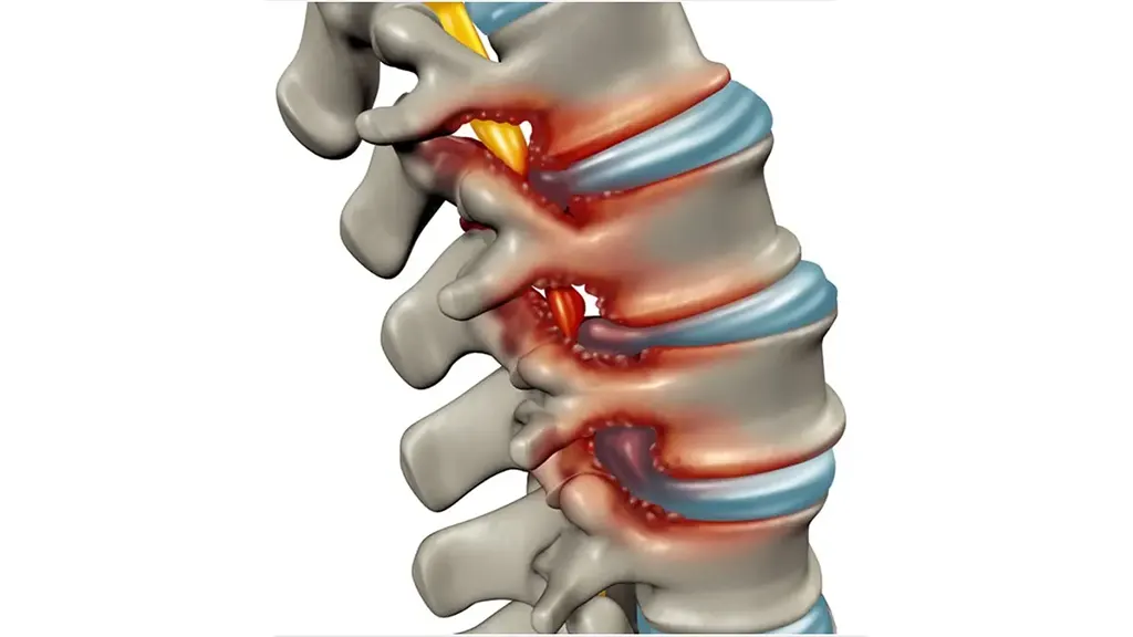 spinal stenosis symptoms
