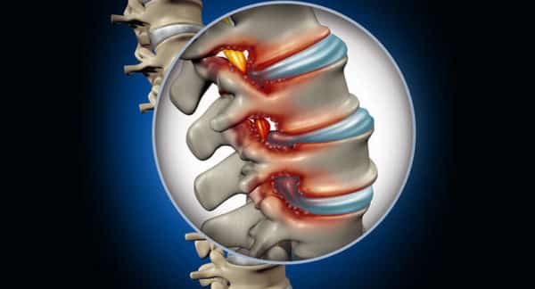 herniated disc slipped disc chiropractic care